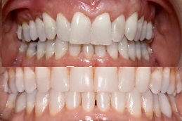 dental-activators-cost in Abu Dhabi