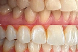 dental-activators-cost in dubai