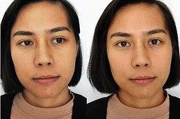 do-glutathione-injections-help-with-weight-loss in Abu Dhabi