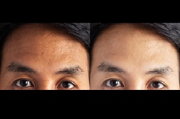 do-glutathione-injections-help-with-weight-loss in dubai