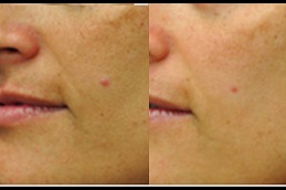 Best eMatrix Treatment in Dubai, Abu Dhabi & Sharjah | Royal