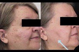 erbium-peeling Clinic in Dubai