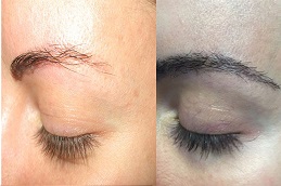 Eyebrow Transplant For Alopecia Areata Dubai Abu Dhabi Royal