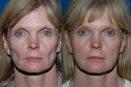 face-fat-transfer Clinic in Dubai