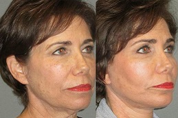 face-fat-transfer in Abu Dhabi