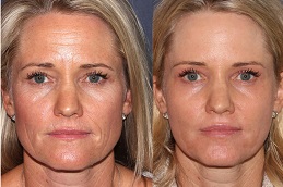 Facial treatment in Dubai