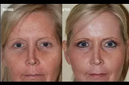 Best facial treatment