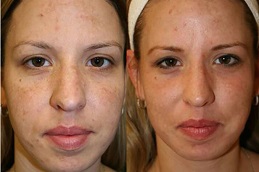 Best facial treatment dubai