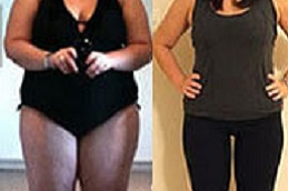 gastric-sleeve-procedure in dubai