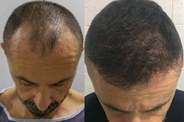 hair-transplant-prices Clinic in Dubai