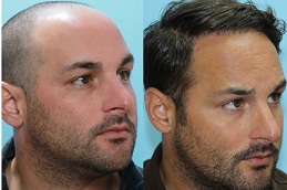 hair-transplant-prices in Abu Dhabi