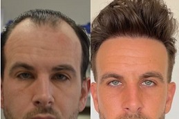 hair-transplant-prices in dubai