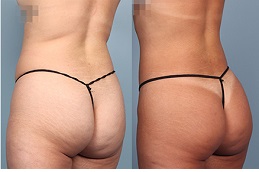 how-long-does-butt-lift-last Clinic in Dubai