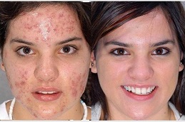 milia-treatment Clinic in Dubai