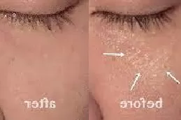 milia-treatment in Abu Dhabi