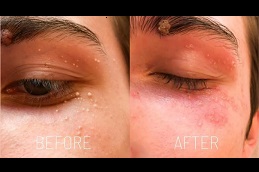 milia-treatment in dubai