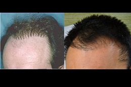 natural-hairline-treatment-cost in dubai