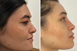 non-surgical nose lift Clinic in Dubai