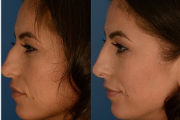 non-surgical nose lift in Abu Dhabi