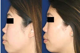 non-surgical-nose-lift-in-dubai