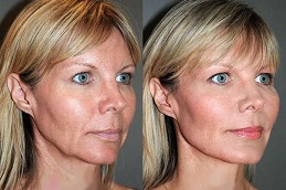 pdo-threads-for-jawlines in dubai