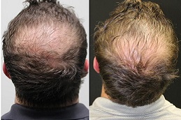 plasma-hair-treatment in Abu Dhabi
