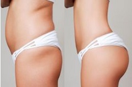 sculptra-injections-buttocks-price-abu dhabi