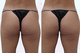 sculptra-injections-buttocks-price clinic in abu dhabi-dubai