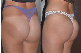 sculptra-injections-buttocks-price-dubai