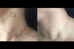 skin-lesion-removal-cost Clinic in Dubai