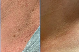 skin-lesion-removal-cost in dubai