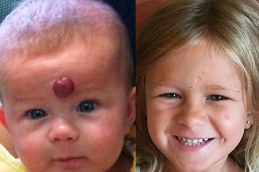 strawberry-hemangioma-treatment-for-baby in dubai