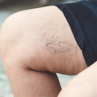 5 Ways to Stop Spider Veins From Spreading in Dubai