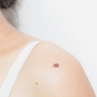 Best Clinic in Dubai & Abu Dhabi for Mole Removal