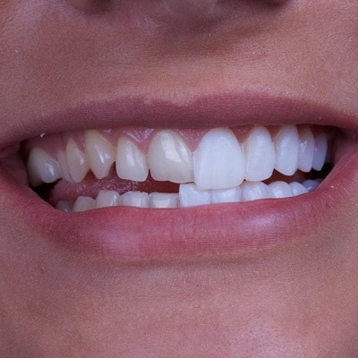 Can You Chew Gum With Dental Veneers in Dubai & Abu Dhabi Cost