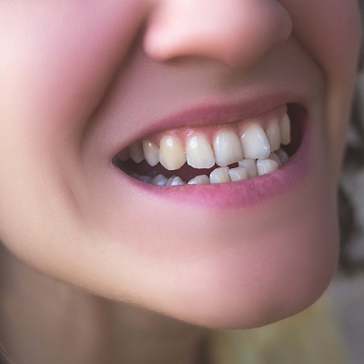 Do You Need Benefit From An Orthodontist to Fix Crooked Teeth?