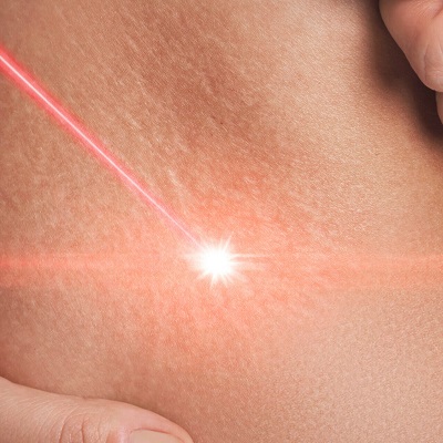 Does Laser Work on Surgical Scars in Dubai