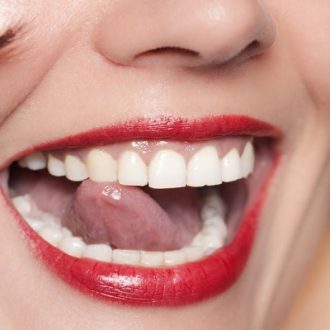 Do’s And Don’ts After Teeth Whitening in Dubai