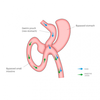 Gastric Bypass Cost in Dubai & Abu Dhabi