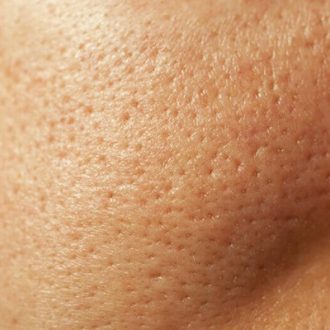 Halo Treatment Cost in Dubai & Abu Dhabi