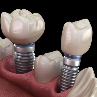 How Long Does Dental Implant Treatment Take