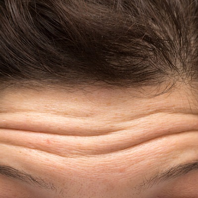 How Long Does a Forehead Lift Last in Dubai?