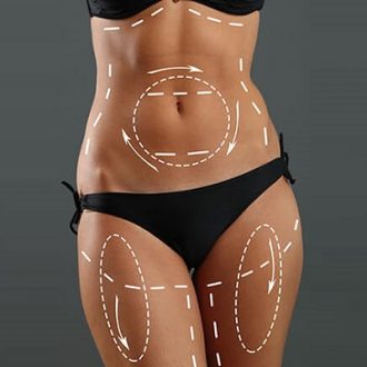 How Long Does It Take To Recover From Liposuction Dubai