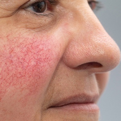 How to Get Rid of Capillaries on the Face?