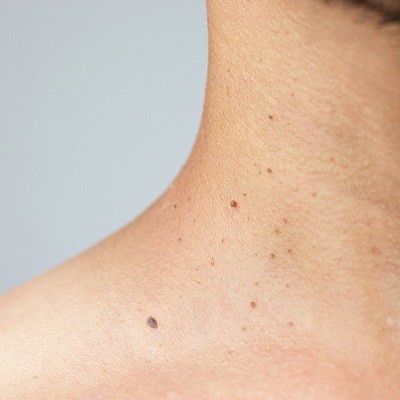 How to Get Rid of Skin Tags Removal in Dubai