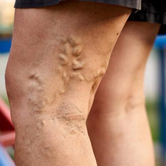 Is Laser Treatment for Varicose Veins Safe in Dubai