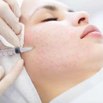 Mesotherapy for Face in Dubai & Abu Dhabi