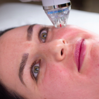Micro-Needling for Acne Scars Cost in Dubai