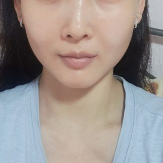 Non-Surgical Face Slimming Treatment in Dubai