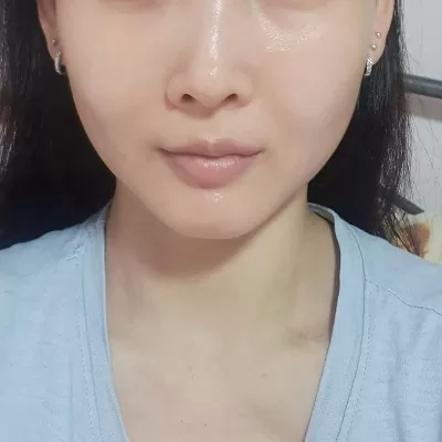 Non-Surgical Face Slimming Treatment in Dubai Cost & Price